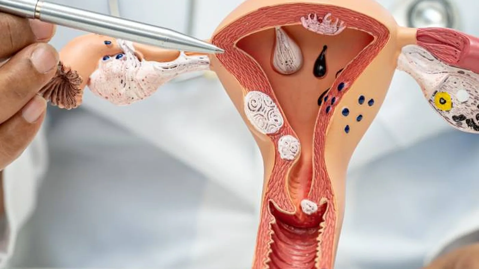 Atención especializada ante retraso o ausencia de menstruación en Tlalnepantla y CDMX